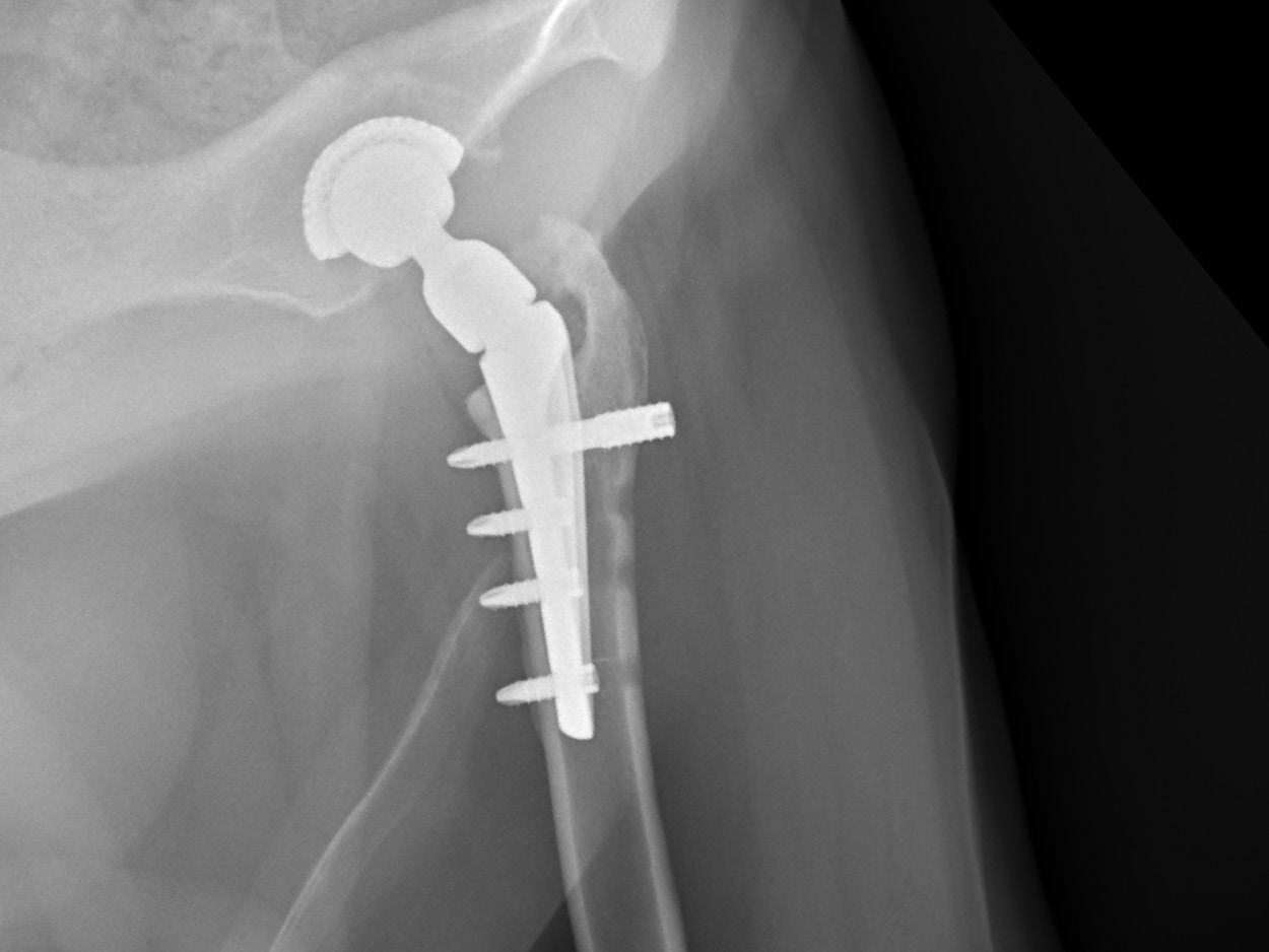 Zurich Cementless- radiograph 600x450px